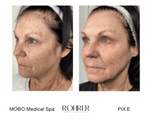 Before and after photos showing facial skin tightening after Rohrer Pix:E treatment.