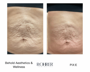 Before and after photos showing skin tightening after Rohrer Pix:E treatment.
