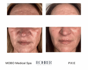 Before and after photos showing facial skin tightening after Rohrer Pix:E treatment.