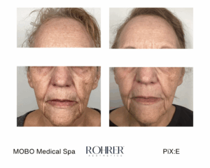 Before and after photos showing facial skin tightening after Rohrer Pix:E treatment.