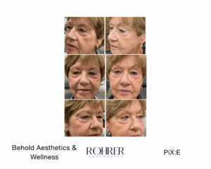 Before and after photos showing skin tightening after Rohrer Pix:E treatment from Behold Aesthetics and Wellness.