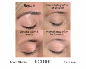 Side-by-side before and after photos showing eyebrow tattoo fading after two sessions of Rohrer PicoLazer treatment from Adorn Studio.