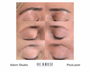 Series of before and after photos showing progressive lightening of eyebrow tattoo pigment over multiple Rohrer PicoLazer treatment sessions.