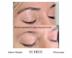 Close-up before and after photos showing eyebrow tattoo pigment lightening immediately after the second Rohrer PicoLazer treatment session.