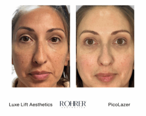 Side-by-side front-facing before and after photos of a woman showing reduced freckles, improved skin tone, and clearer complexion after Rohrer PicoLazer treatment.