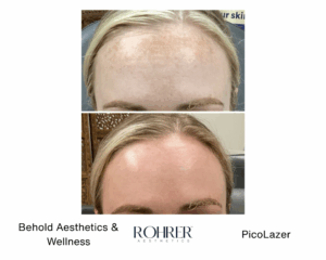 Side-by-side before and after photos of a woman’s forehead showing significant reduction in pigmentation and sun damage after Rohrer PicoLazer treatment.