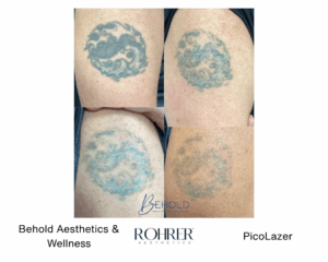 Series of before and after photos showing progressive fading of a blue and black wave tattoo on the upper arm after Rohrer PicoLazer treatments.
