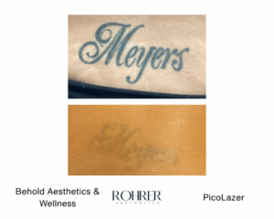 Before and after photos showing dramatic fading of a black script tattoo reading “Meyers” after Rohrer PicoLazer treatment.