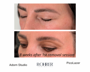 Before and after photos showing eyebrow tattoo lightening eight weeks after the first Rohrer PicoLazer removal session.