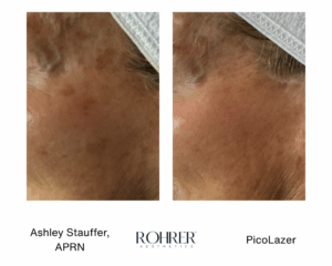 Side-by-side before and after photos of facial skin showing significant reduction of dark spots and hyperpigmentation after Rohrer PicoLazer treatment.