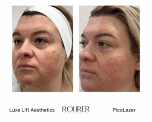 Side-by-side angled before and after photos of a woman showing reduced facial pigmentation, improved skin clarity, and smoother texture after Rohrer PicoLazer treatment.