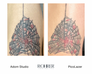 Side-by-side before and after photos of a spiderweb tattoo on skin showing lightening of black and red ink after Rohrer PicoLazer treatment.