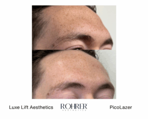 Side-by-side before and after photos of a man’s forehead showing reduced freckles and more even skin tone after Rohrer PicoLazer treatment.