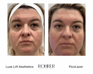 Side-by-side front-facing before and after photos of a woman showing reduced pigmentation, improved skin texture, and more even tone after Rohrer PicoLazer treatment.