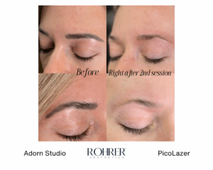 Side-by-side before and after photos showing eyebrow tattoo fading after two sessions of Rohrer PicoLazer treatment.