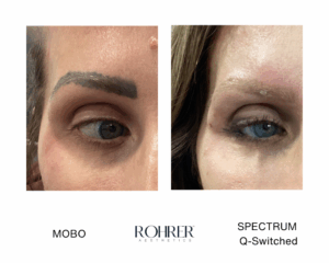 Before and after photo of a woman's eye showing improved skin texture after a Rohrer Aesthetics Spectrum Q-Switched Treatment.