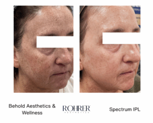 Before and after comparison of a women's face,showing visible improvements in skin texture and overall appearance after Spectrum IPL treatment with Behold Aesthetics and Wellness