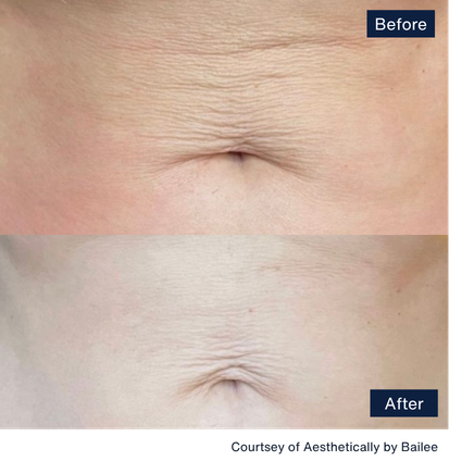 Before and after of tone and tight treatment from Rohrer Aesthetics, using PiXel8-RF and BodyTone devices