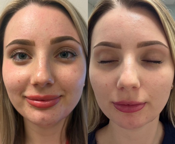 Before and after ReLumina IPL treatment of a woman's face by Rio Calvert, NP-C